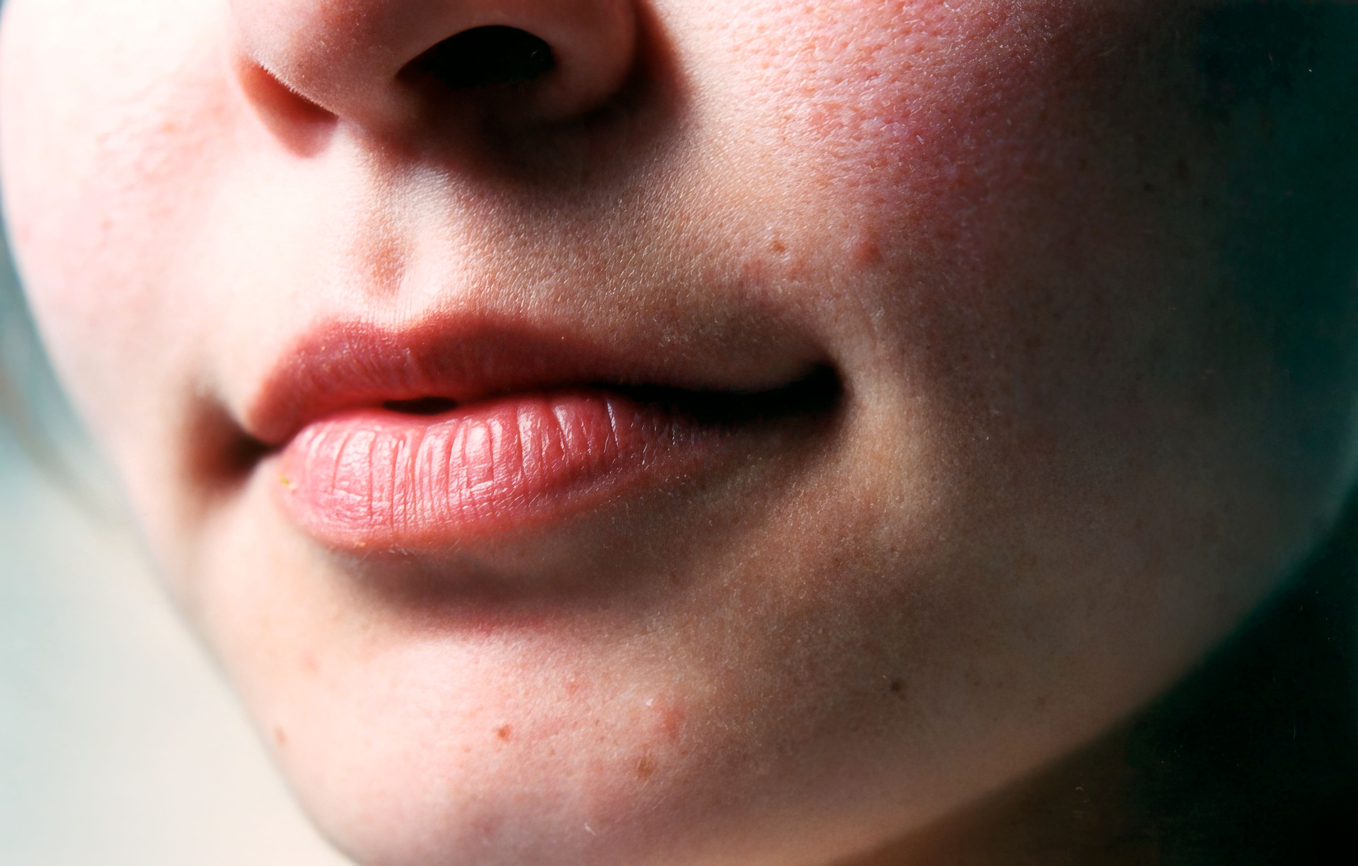 Dapalen gel is a new acne treatment medication in Belarus!